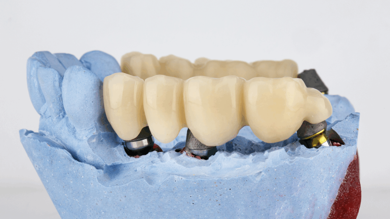 Tooth Replacement Options in La Grange, TX: Bridges, Crowns, and Dentures