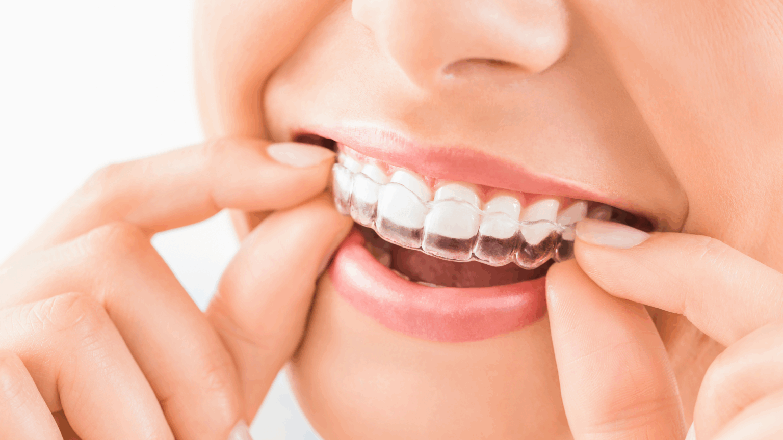 Small Town, Modern Dentistry: Clear Aligners in La Grange