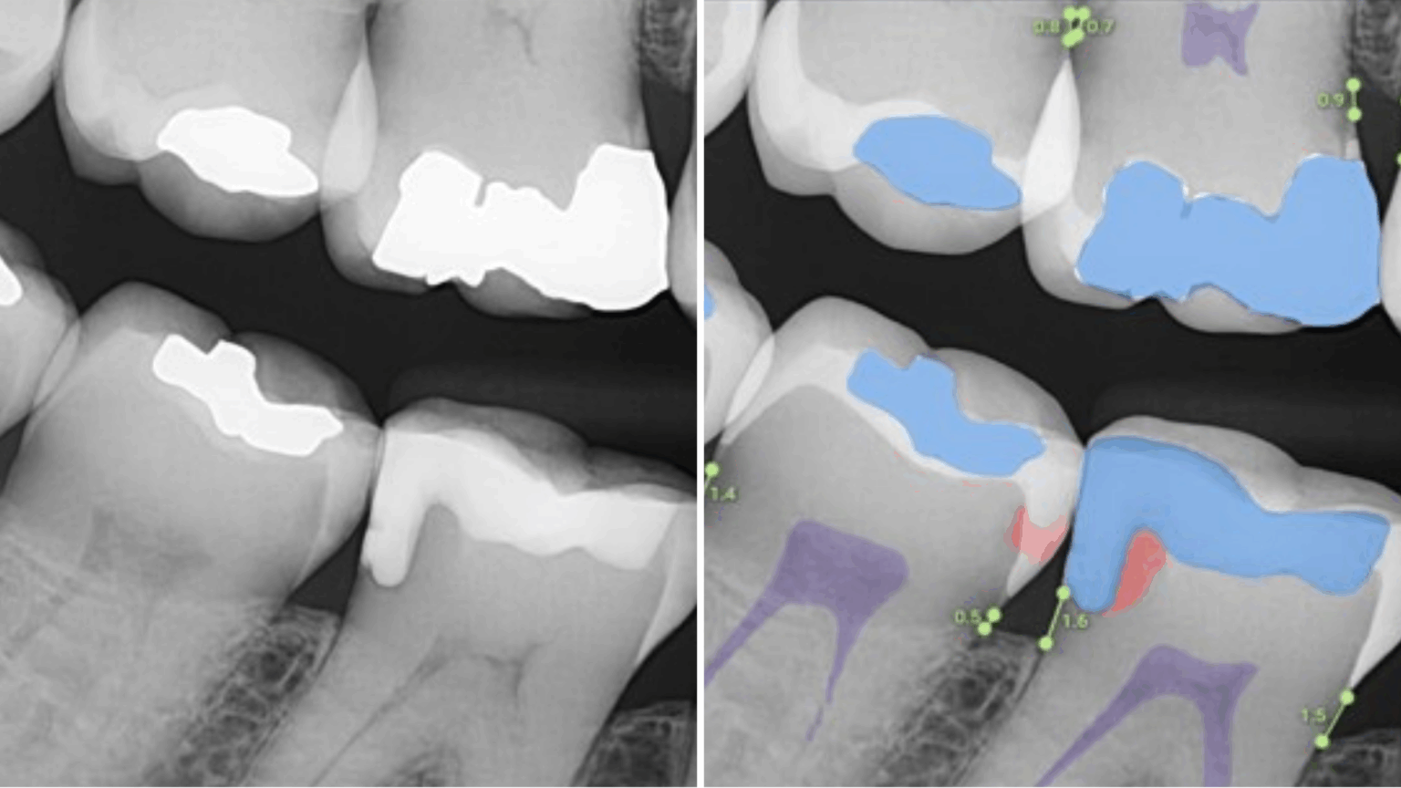 Digital Dentistry with a Human Touch: How Overjet AI Benefits You at CornerStone Dental