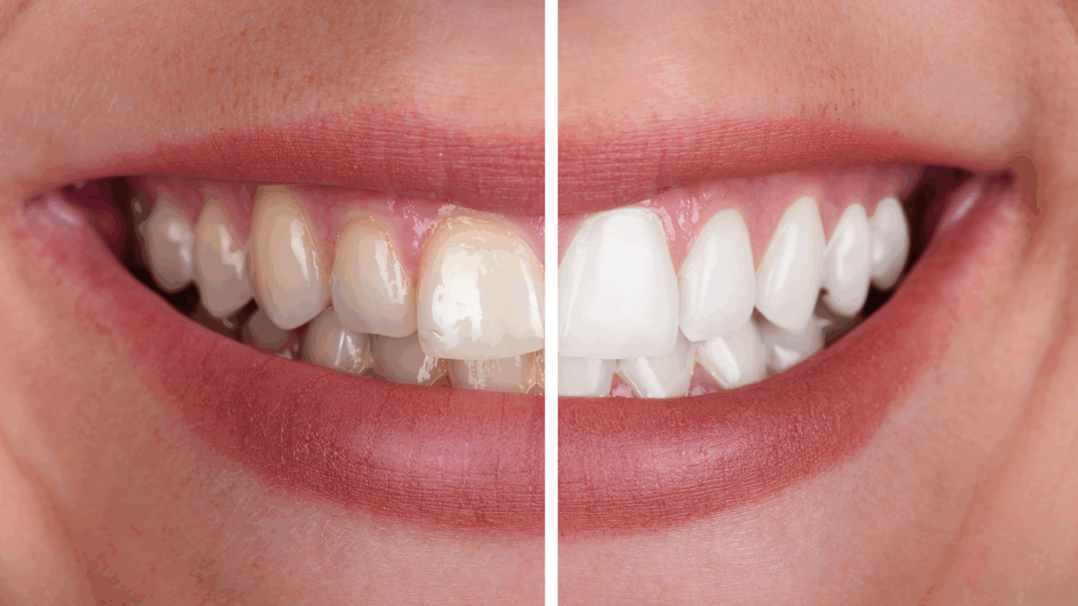 Should You Whiten Your Smile with Teeth Whitening? Answer These Questions First