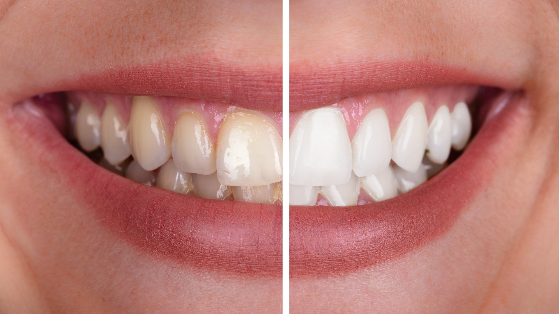 Should You Whiten Your Smile with Teeth Whitening? Answer These Questions First