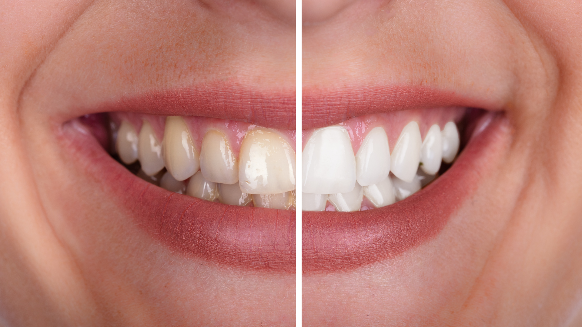 When Should You See a Dentist for Yellow Teeth?